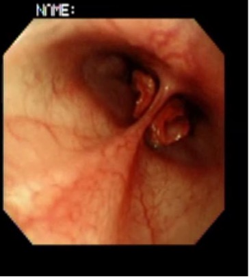 Endoscopic view of caudal aberrant turbinates protruding in the nasopharynx