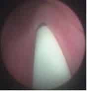Minimally invasive ectopic ureter surgery 1