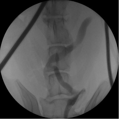 Minimally invasive ectopic ureter surgery 2