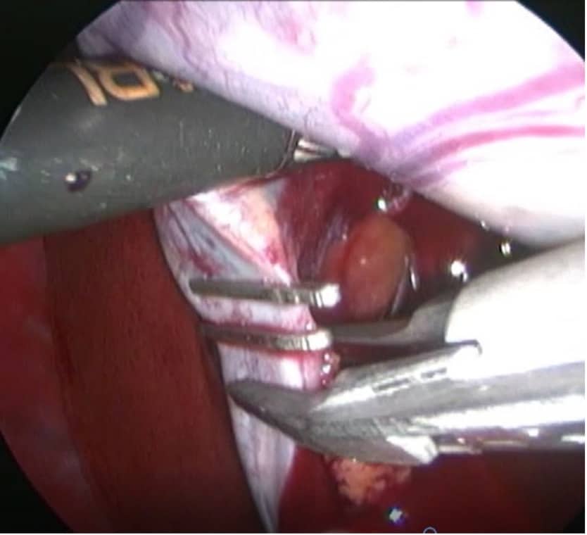 key-hole gallbladder removal