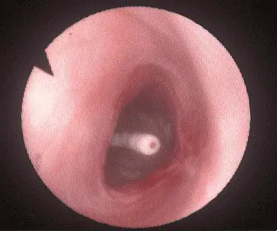 Massimo's nasal cavity after a balloon dilation